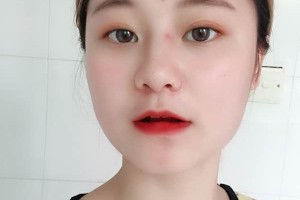 杭州芯美昕整形醫(yī)院怎么樣割雙眼皮案例全過(guò)程