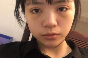 廈門海峽整形醫(yī)院雙眼皮果？附果圖及案例展示