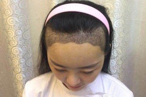 ?？谑腥嗣襻t(yī)院植發(fā)怎樣附果圖