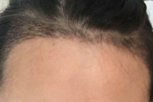 北京同仁醫(yī)院整形美容外科怎么樣？（附果圖）