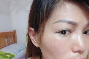 武漢同濟醫(yī)院激光怎么樣附果圖