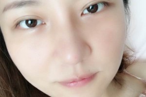 武漢亞太整形隆鼻怎么樣？真人案例+醫(yī)生介紹