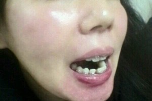 昆明延安醫(yī)院口腔科牙齒矯正&真人案例+醫(yī)生介紹