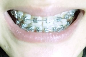 株洲家鴻口腔醫(yī)院牙齒矯正/術(shù)后果&價(jià)格表