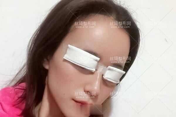 寧波113整形美容醫(yī)院？雙眼皮3個月果|整形專家詳情