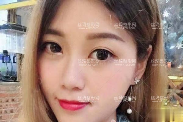 濟(jì)南集美整形可靠嗎？雙眼皮90天恢復(fù)日記價(jià)格表