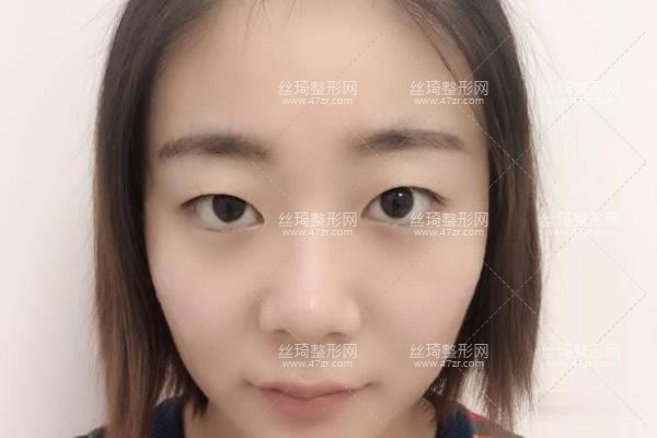 河南省人民醫(yī)院整形科王凱雙眼皮？知名醫(yī)生推薦&費用表