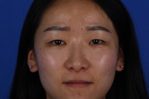 上海永惠華門診部好不好？雙眼皮術(shù)后恢復(fù)事項