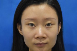 空軍總醫(yī)院隆鼻的費用？2021費用表+醫(yī)生推薦