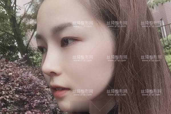 西安市第四醫(yī)院美容科價(jià)格表公布隆鼻3個(gè)月果|整形專家詳情