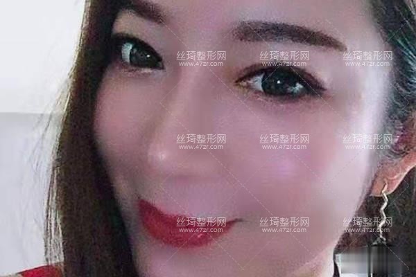 南昌大學(xué)美容醫(yī)院怎樣假體隆鼻日記|價目表|醫(yī)生評價