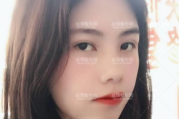 上海九院怎么樣？雙眼皮3個(gè)月果|整形專家詳情