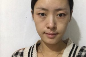 華康整形醫(yī)院正規(guī)嗎？隆鼻成功案例&費(fèi)用表
