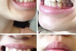 西安中諾口腔醫(yī)院評(píng)價(jià)？牙齒矯正成功案例分享！