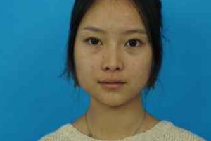 濟(jì)南華僑醫(yī)院雙眼皮咋樣？醫(yī)生技術(shù)如何/費(fèi)用表