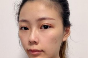 南方醫(yī)院苗勇植發(fā)果好不好？真實(shí)案例分享