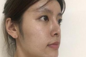 京民整形醫(yī)院假體隆鼻靠譜嗎？親身經(jīng)歷分享&對比圖