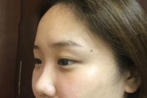 武漢協(xié)和醫(yī)院美容科怎么樣 ？去眼袋果圖