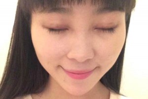 臨沂市人民醫(yī)院雙眼皮怎么樣？注意事項(xiàng)+術(shù)前準(zhǔn)備必看