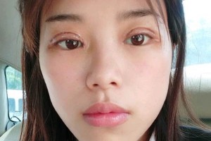 長沙亞韓整形醫(yī)院雙眼皮價(jià)格？術(shù)后幾點(diǎn)需注意！