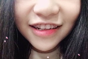 江蘇邳州口腔靠譜嗎？牙齒矯正的價格表!