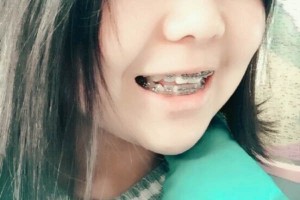 四川華西口腔醫(yī)院？牙齒矯正術(shù)后分享！