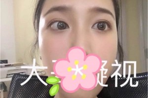 成都西嬋整形醫(yī)院雙眼皮術(shù)后恢復(fù)記錄！快看