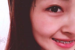 西安中諾口腔牙齒矯正價目表—術(shù)后護(hù)理分享