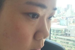 成都恩喜整形醫(yī)院膨體隆鼻正規(guī)嗎？醫(yī)生推薦