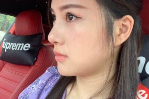 上海九院整形科/下頜角真實(shí)案例實(shí)拍