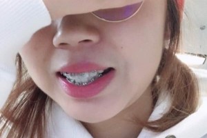 上海摩爾口腔/牙齒矯正真實案例&果圖