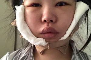 鄭大一附院有整形科怎么樣？下頜角術(shù)真實(shí)案例|醫(yī)生推薦