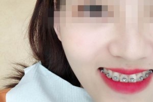 青島優(yōu)諾博士口腔醫(yī)院牙齒矯正怎么樣？恢復(fù)圖分享