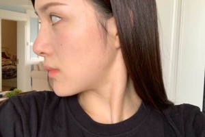 廈門第一醫(yī)院美容科下頜角怎么樣？術(shù)前術(shù)后對(duì)比圖！