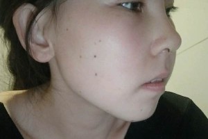 協(xié)和醫(yī)院整形科硅膠隆鼻價(jià)位？真實(shí)案例分享！