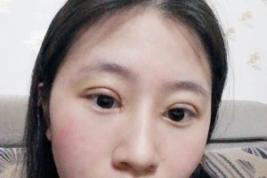 南昌大學(xué)美容醫(yī)院切開雙眼皮是正規(guī)嗎？附果圖&價格表