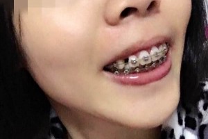 北京億大口腔醫(yī)院牙齒矯正怎么樣？附較新價(jià)格表！