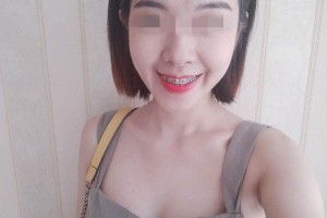 南京口腔醫(yī)院牙齒矯正哪個(gè)醫(yī)生好/真實(shí)案例對(duì)比！