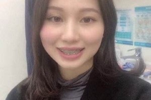 濟(jì)南圣貝口腔醫(yī)院牙齒矯正怎么樣/真實(shí)案例對比！
