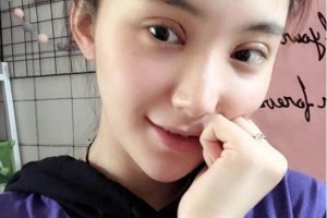 上海千美醫(yī)療美容院定點(diǎn)雙眼皮？術(shù)后術(shù)前明X果～