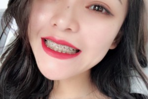 重慶美奧口腔醫(yī)院怎么樣？附醫(yī)院信息+正畸果圖