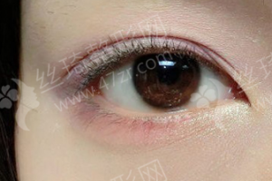 西安做雙眼皮醫(yī)生排行榜醫(yī)生優(yōu)勢簡介|醫(yī)生優(yōu)勢介紹，雙眼皮項(xiàng)目術(shù)后體驗(yàn)感受點(diǎn)評